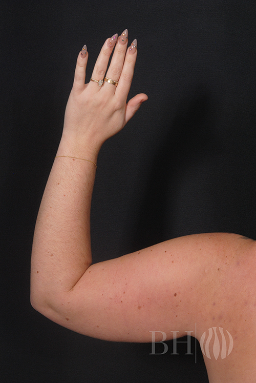 Arm Lift Before & After